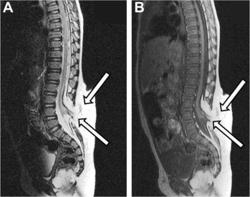 Spinal Dysraphism